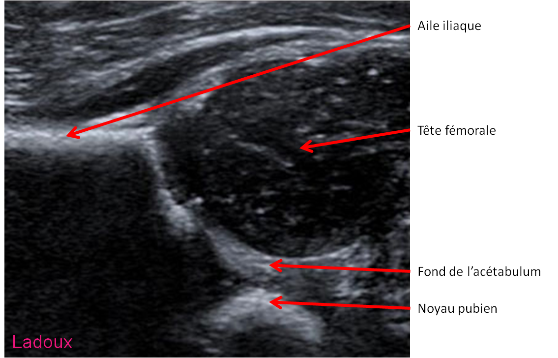 Echographie de hanche anatomie