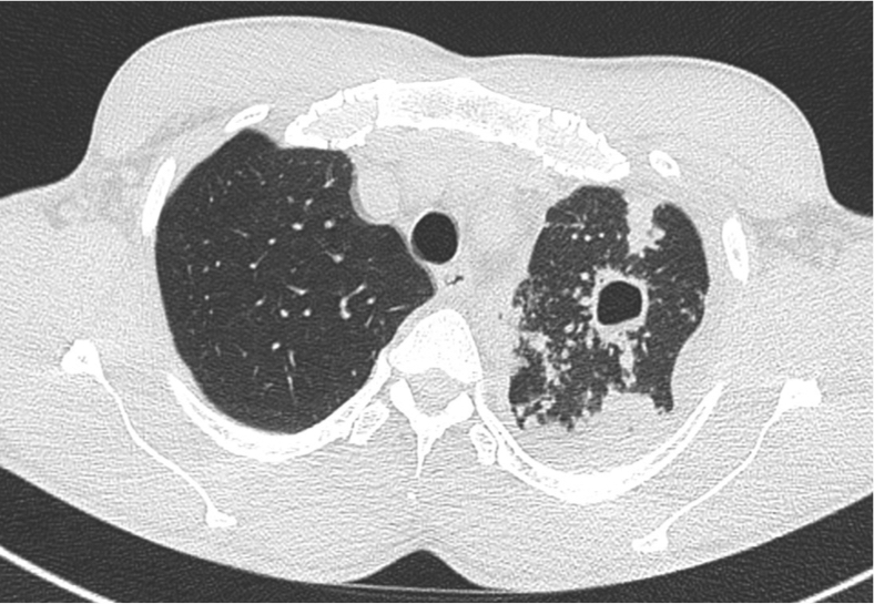 Tuberculose pulmonaire de localisation lobaire supérieure gauche. Nodule excavé et foyer micronodulaire bronchiolaire périphérique. 