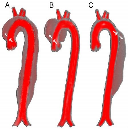 Aortic_dissection_class