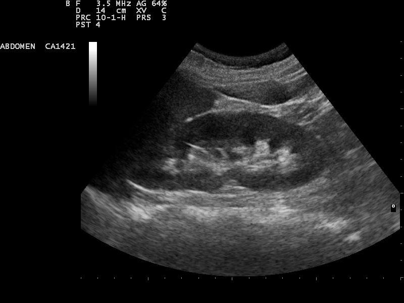 Kidney_ultrasound_110315132820_1329070