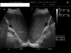 Case courtesy of Dr M Osama Yonso, Radiopaedia.org. From the case rID: 17573