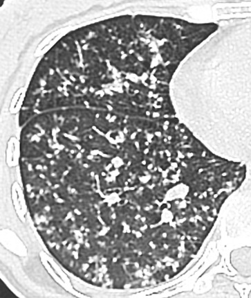 Case courtesy of Dr Prashant Mudgal, Radiopaedia.org. From the case rID: 41197