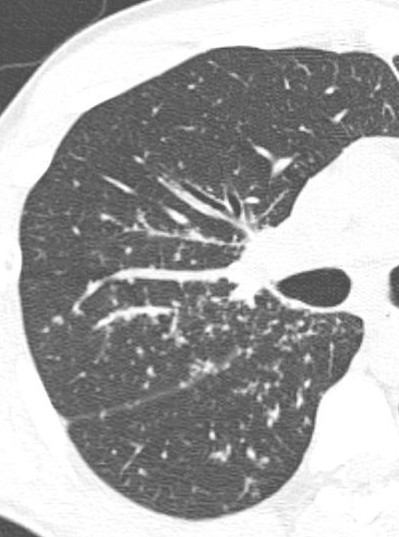 Case courtesy of Dr Mahomed A. Osman, Radiopaedia.org. From the case rID: 22081