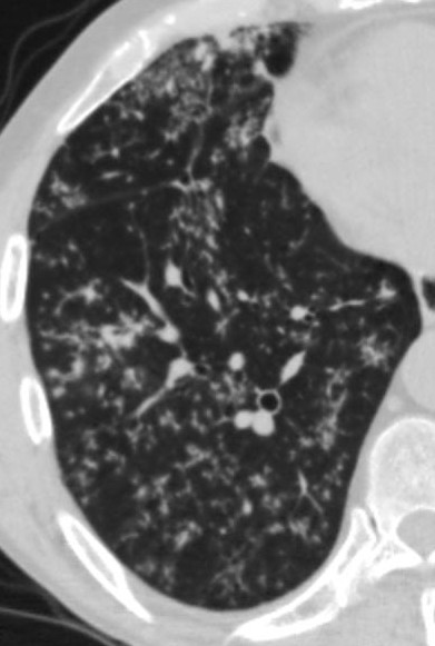 Case courtesy of Dr Juan Jose Urquiza, Radiopaedia.org. From the case rID: 25554