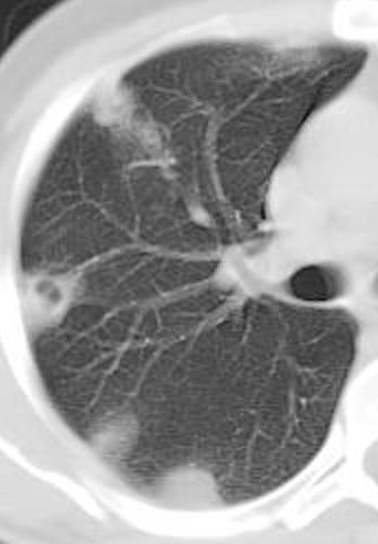 Case courtesy of Dr Ahmed Abd Rabou, Radiopaedia.org. From the case rID: 23250