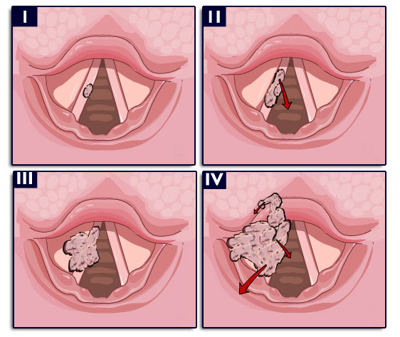 Cancer de la corde vocale Source : http://www.palli-science.com/imageries-cou-orl