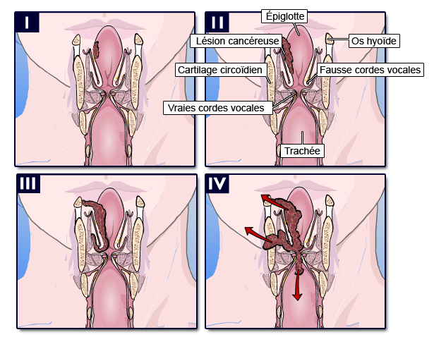 Cancer supraglottique Source : http://www.palli-science.com/imageries-cou-orl