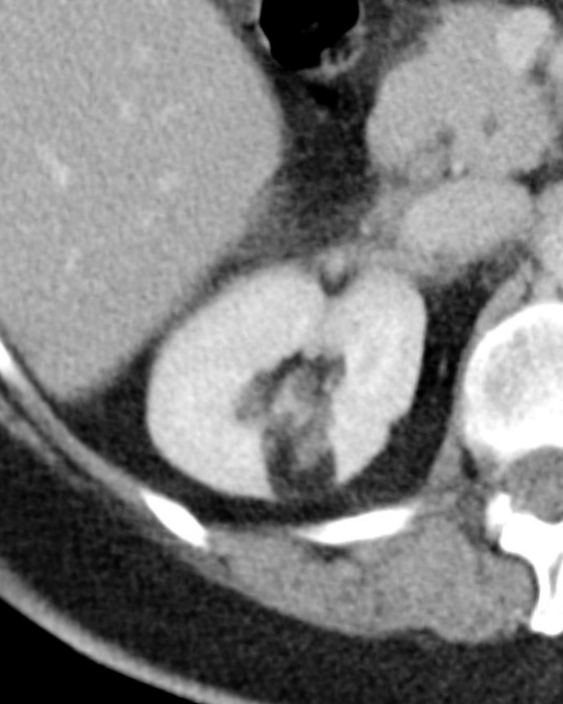 renal-angiomyolipoma-11