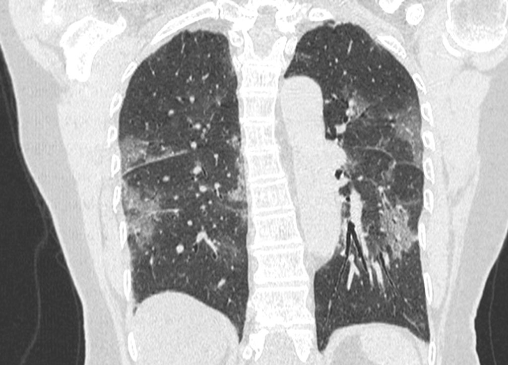 Thorax – PinkyBone